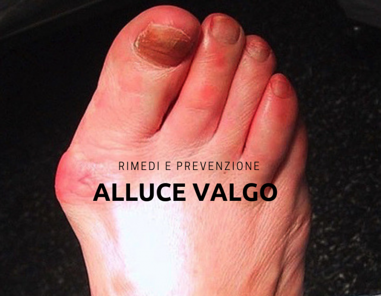 Alluce valgo: di cosa si tratta, prevenzione e trattamento